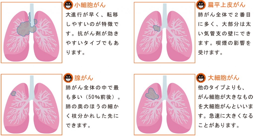 肺がんの種類
